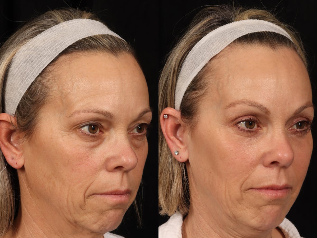 Chin Implant Before & After Gallery - Patient 134622 - Image 2