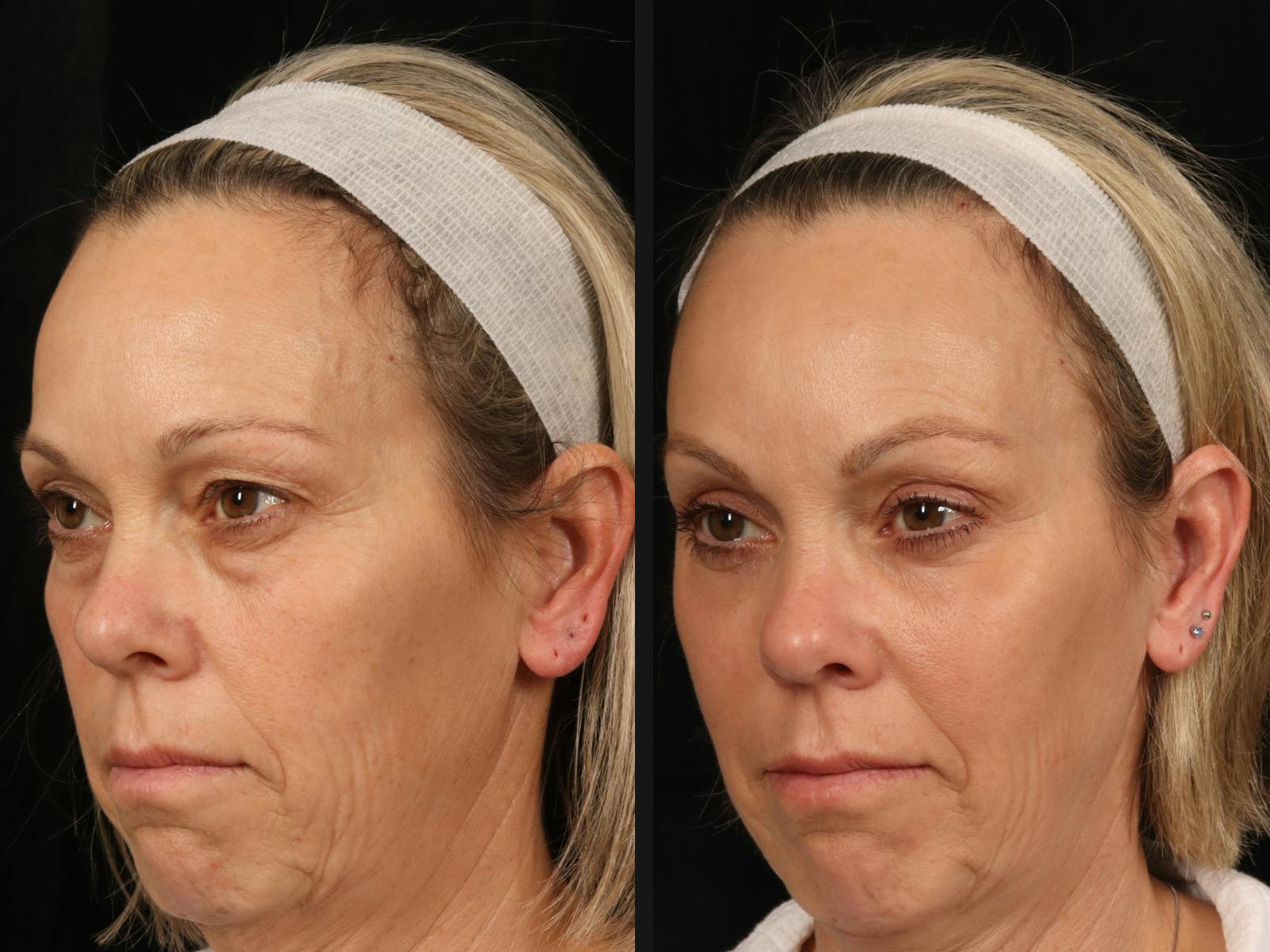 Mid Facelift Before & After Gallery - Patient 327449 - Image 3