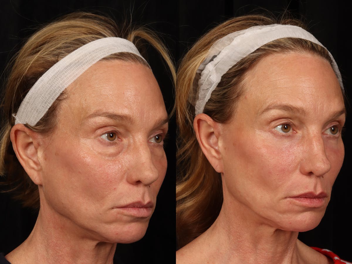 Laser Skin Resurfacing Before & After Gallery - Patient 114864 - Image 3