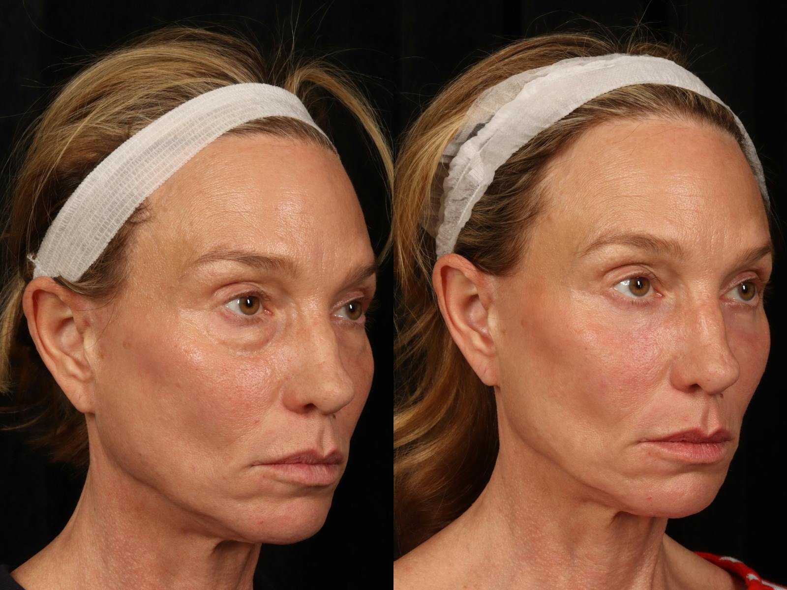 Laser Skin Resurfacing Before & After Gallery - Patient 114864 - Image 3