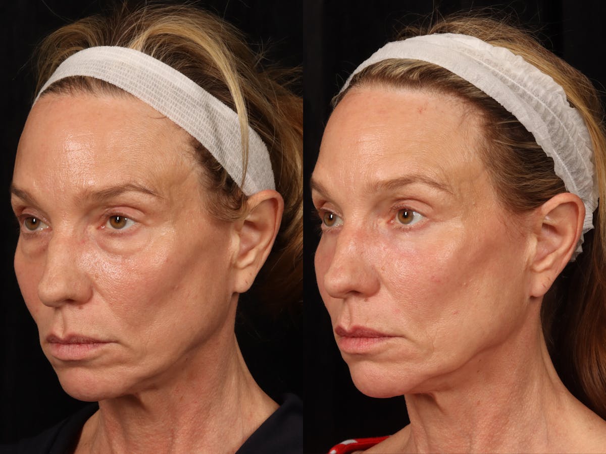 Laser Skin Resurfacing Before & After Gallery - Patient 114864 - Image 2