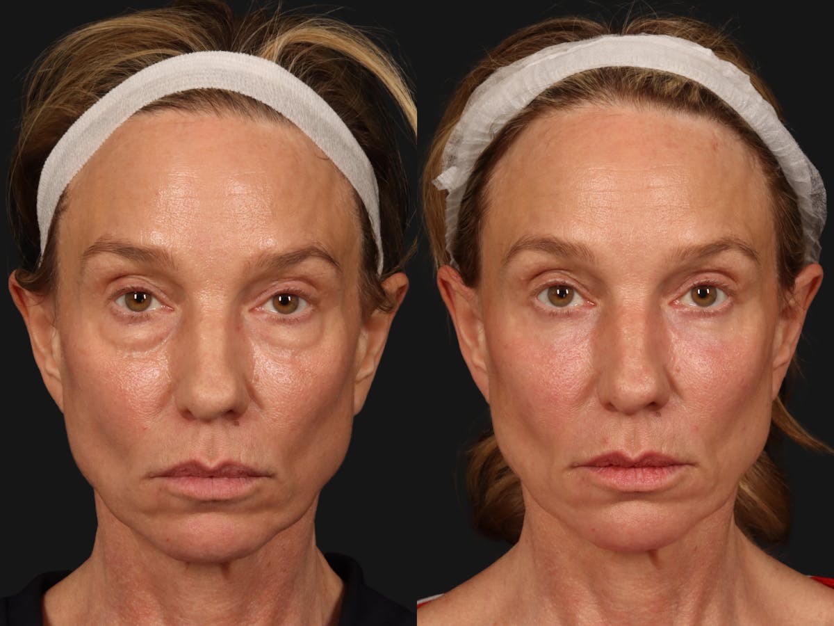 Laser Skin Resurfacing Before & After Gallery - Patient 114864 - Image 1