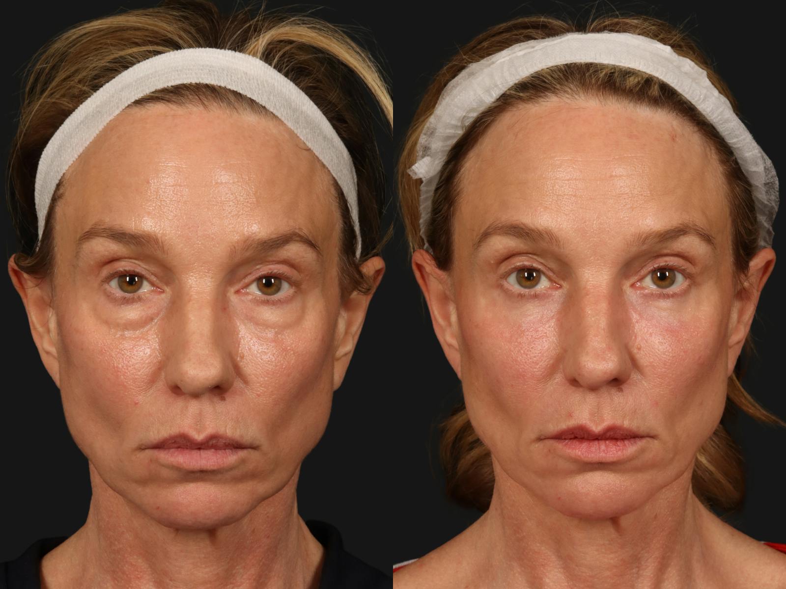 Blepharoplasty Before & After Gallery - Patient 426655 - Image 1