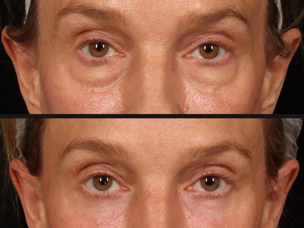 Blepharoplasty Before & After Gallery - Patient 426655 - Image 2