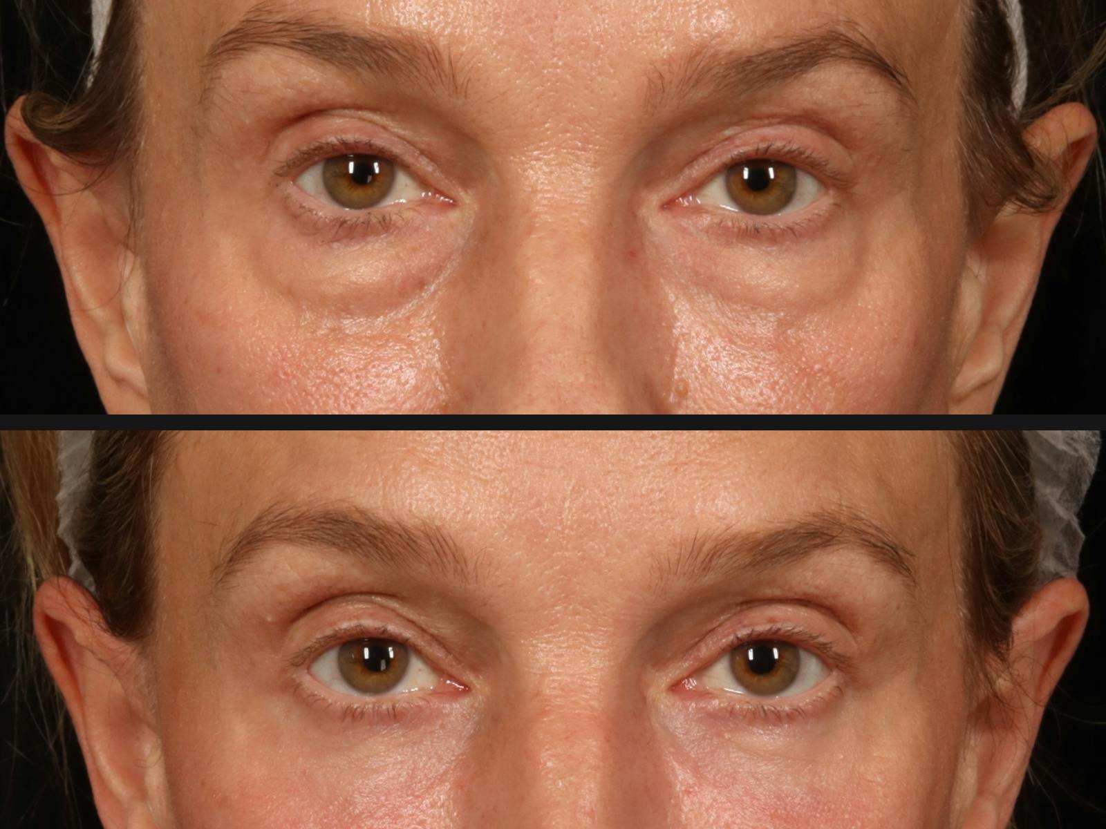 Blepharoplasty Before & After Gallery - Patient 426655 - Image 2