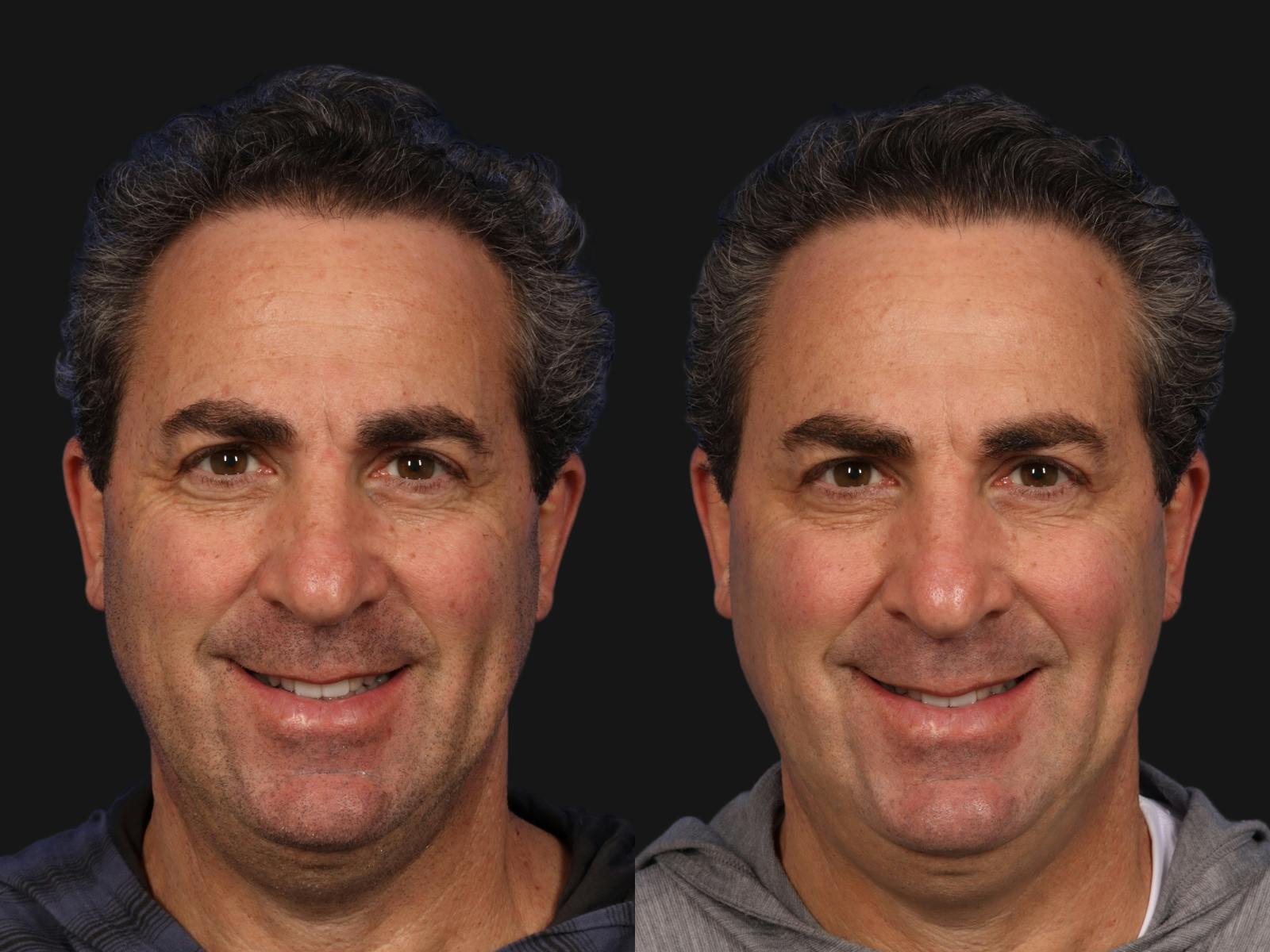 BOTOX® Before & After Gallery - Patient 416917 - Image 1