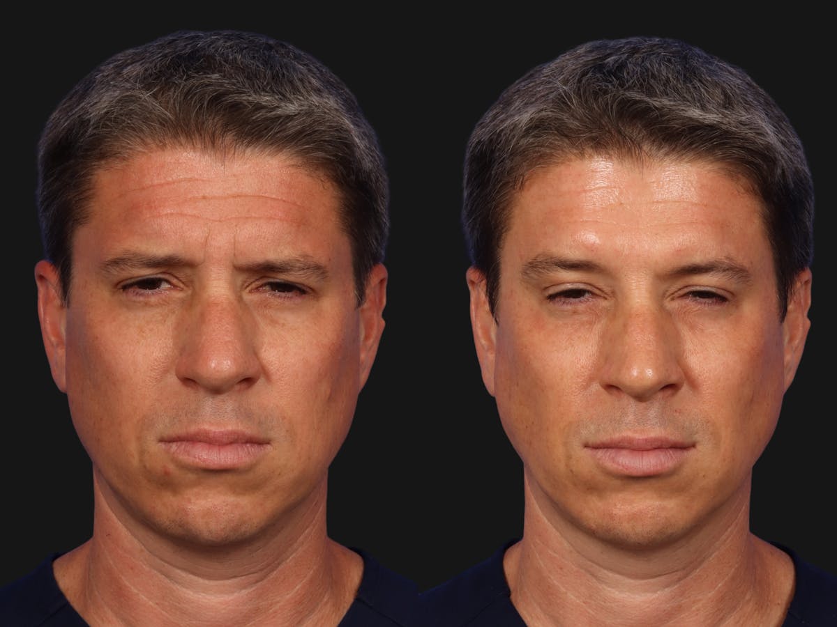 BOTOX® Before & After Gallery - Patient 131397 - Image 3