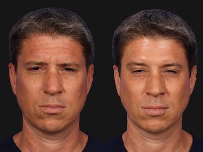 BOTOX® Before & After Gallery - Patient 131397 - Image 3
