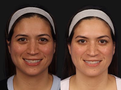 BOTOX® Before & After Gallery - Patient 220841 - Image 1