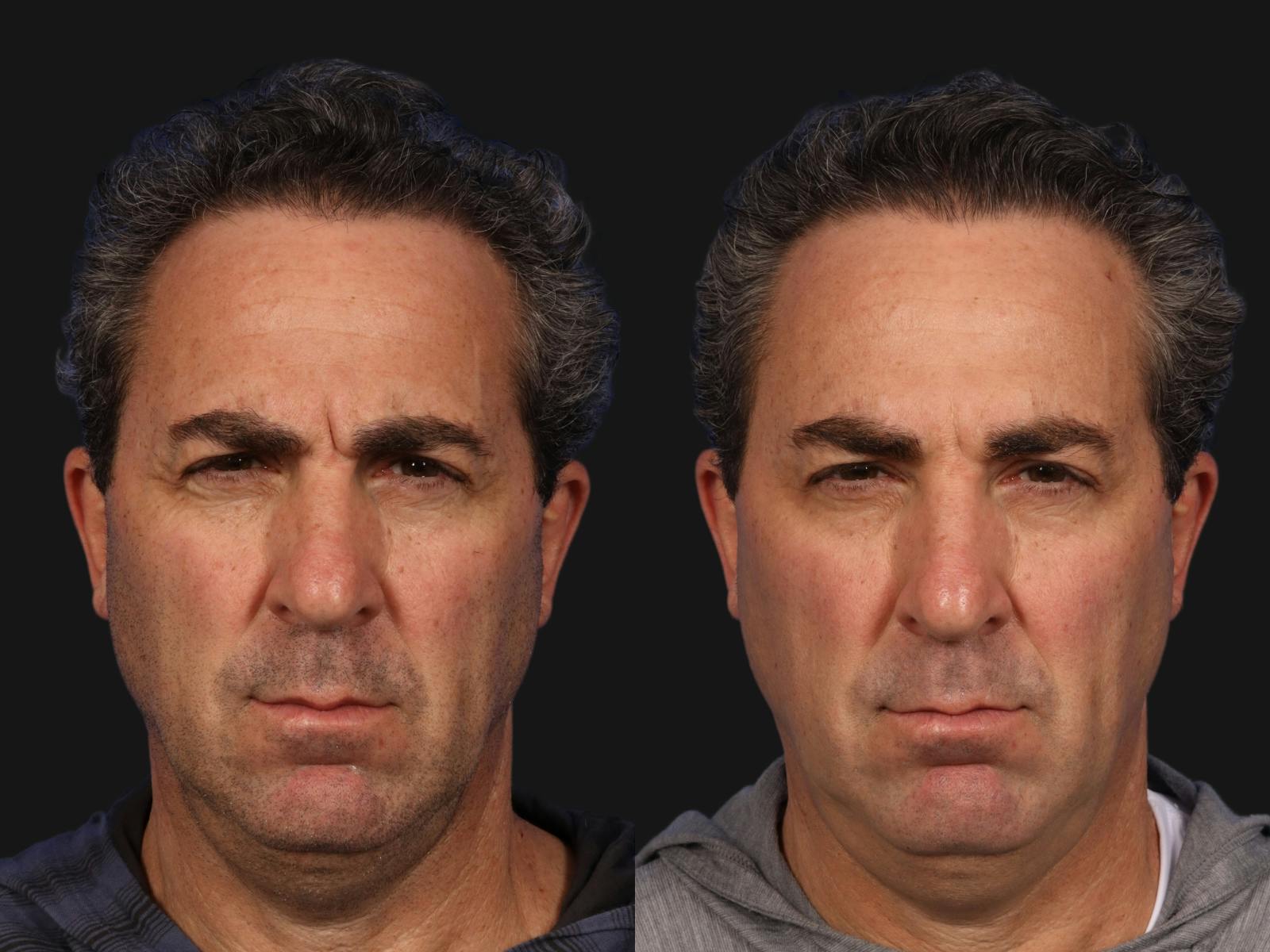 BOTOX® Before & After Gallery - Patient 416917 - Image 2