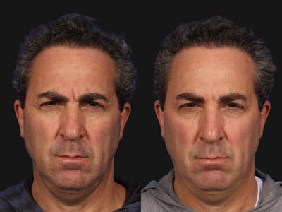 BOTOX® Before & After Gallery - Patient 416917 - Image 2