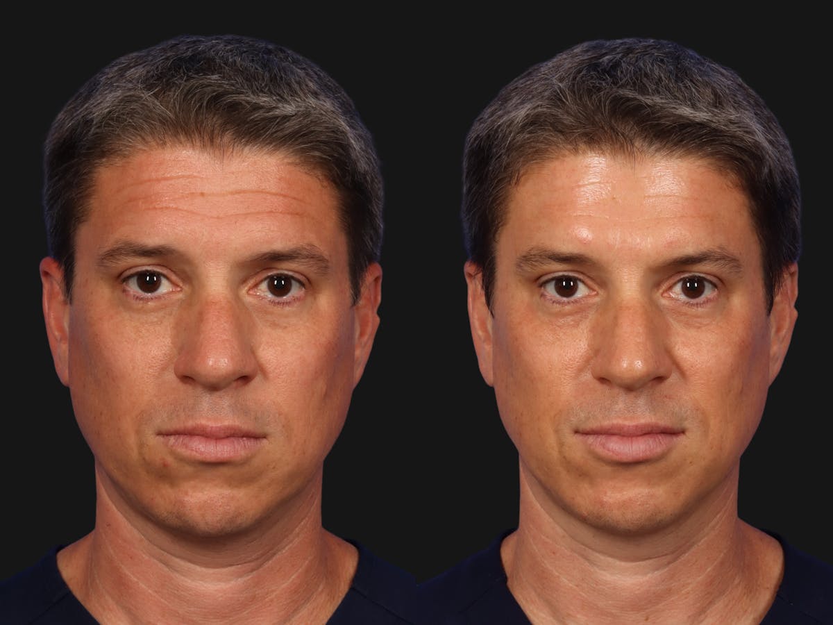 BOTOX® Before & After Gallery - Patient 131397 - Image 1