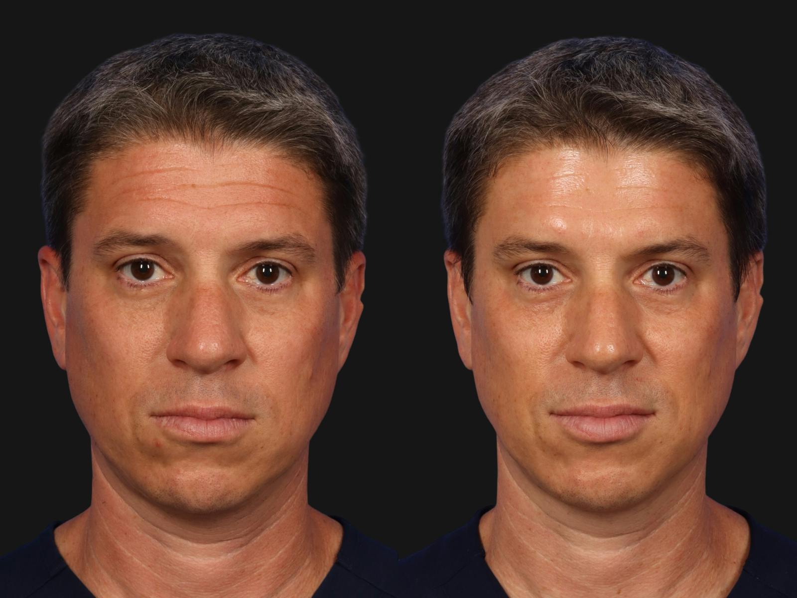 BOTOX® Before & After Gallery - Patient 131397 - Image 1