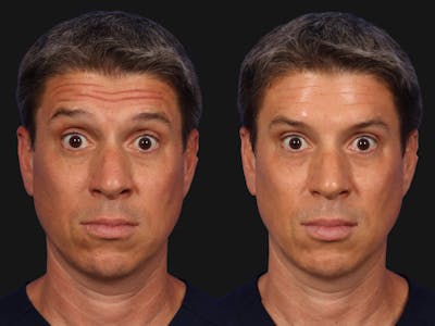 BOTOX® Before & After Gallery - Patient 131397 - Image 2