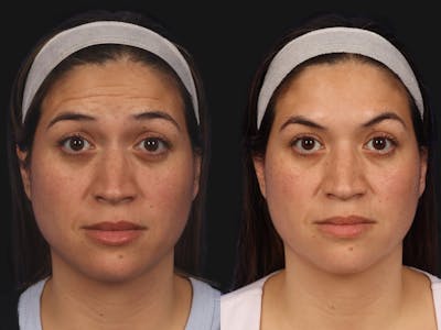 BOTOX® Before & After Gallery - Patient 220841 - Image 2