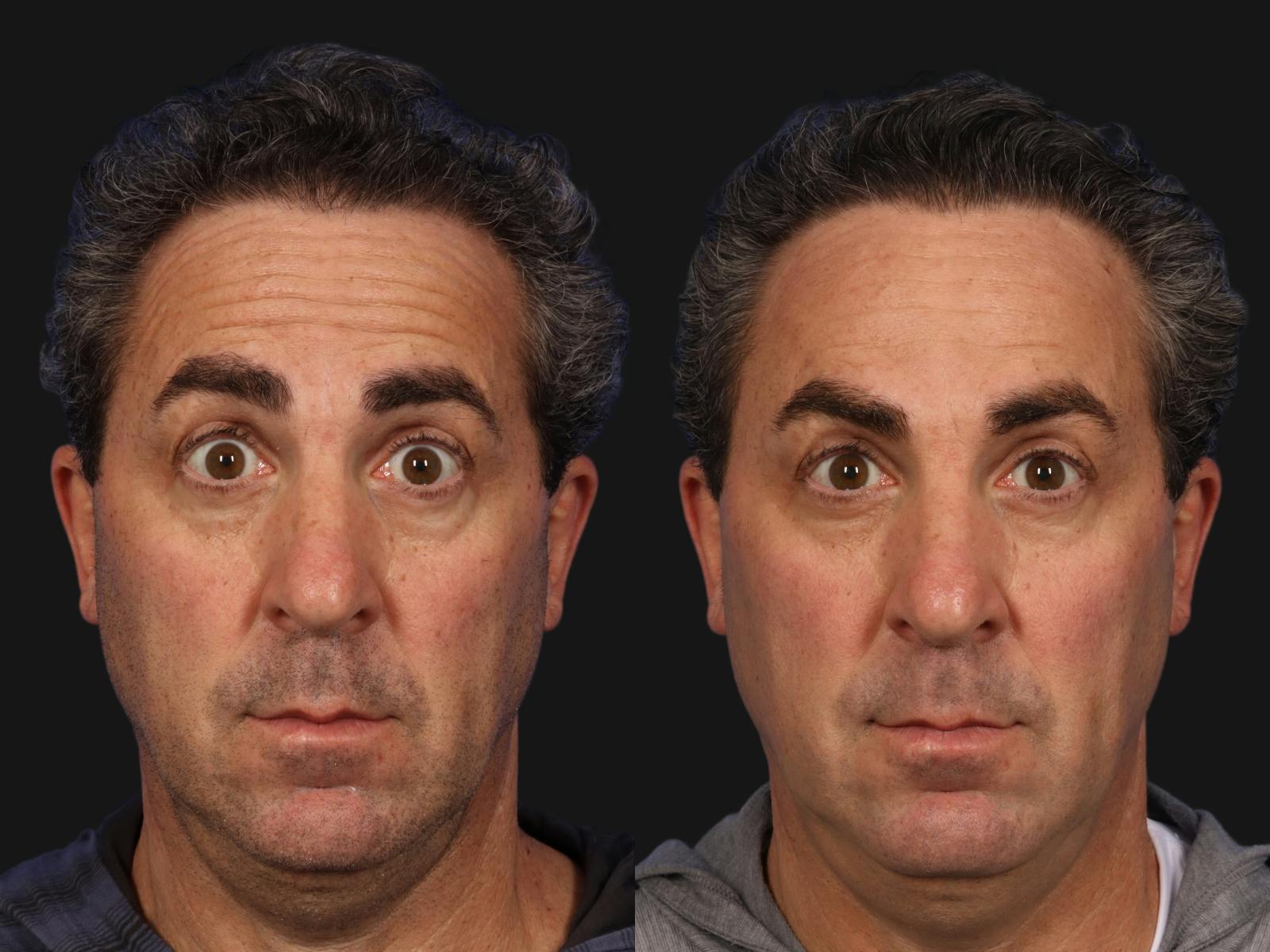 BOTOX® Before & After Gallery - Patient 416917 - Image 3