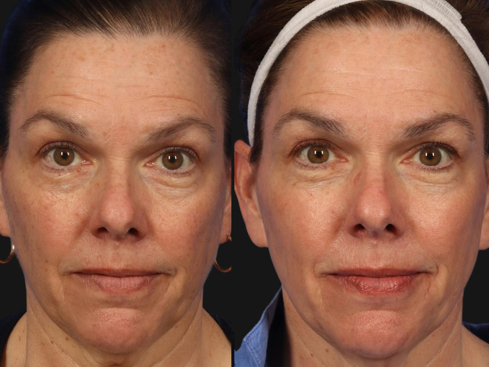 BBL (IPL Treatments) Before & After Gallery - Patient 245500 - Image 1