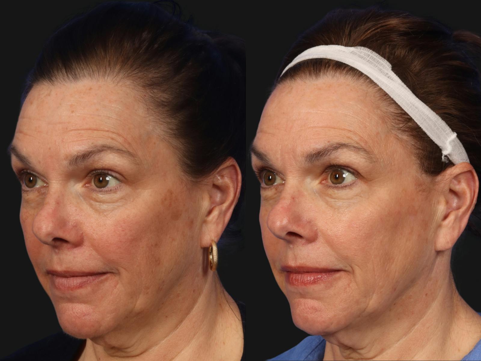 BBL (IPL Treatments) Before & After Gallery - Patient 245500 - Image 2