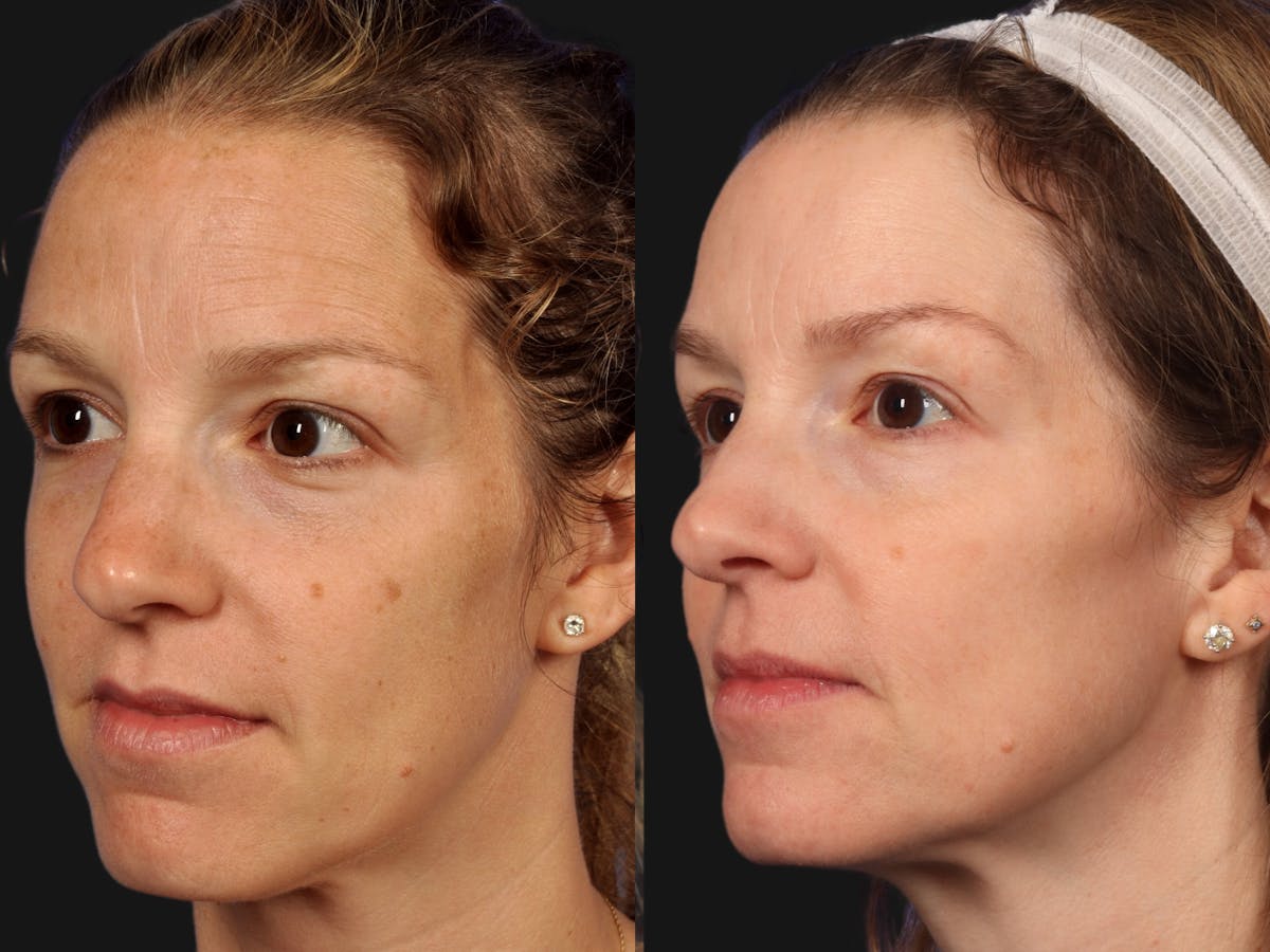 BBL (IPL Treatments) Before & After Gallery - Patient 186377 - Image 1