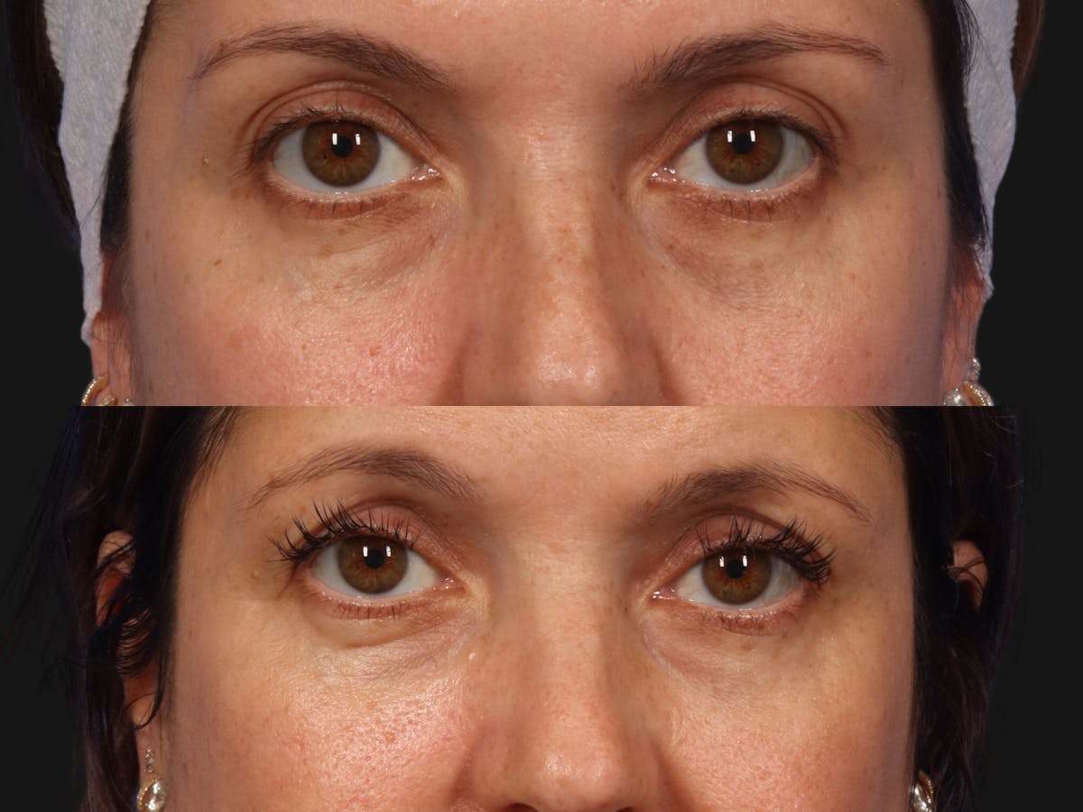 BBL (IPL Treatments) Before & After Gallery - Patient 347382 - Image 1