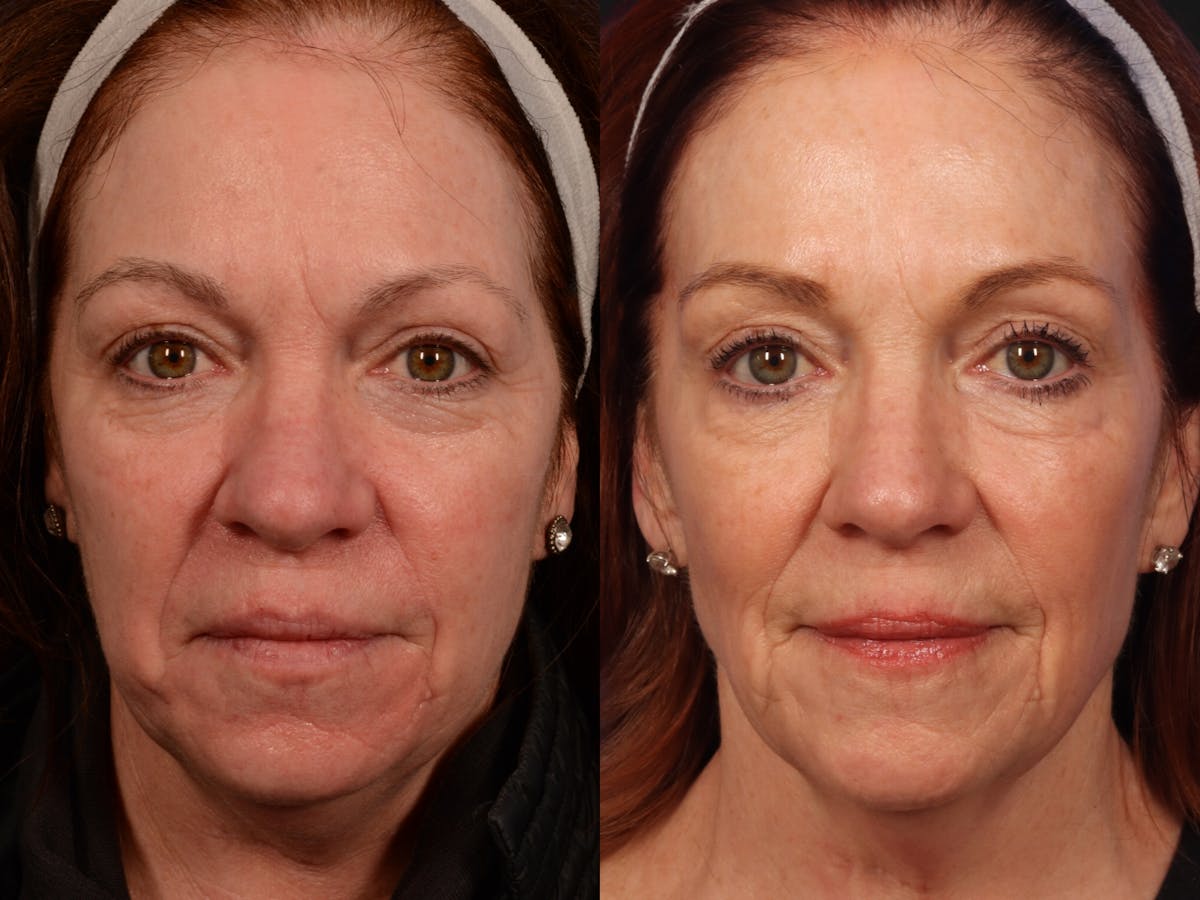 UltraClear™ Laser Before & After Gallery - Patient 928479 - Image 1