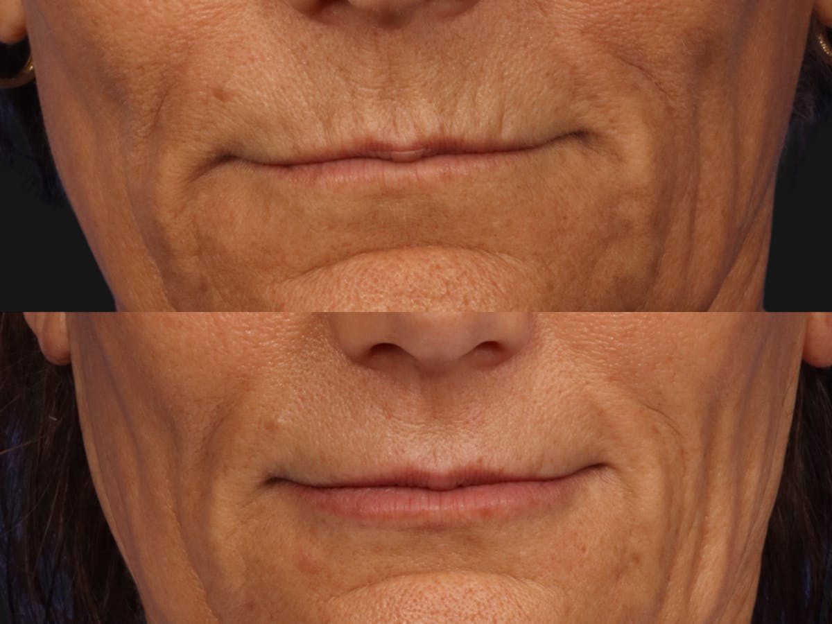 UltraClear™ Laser Before & After Gallery - Patient 106868 - Image 1