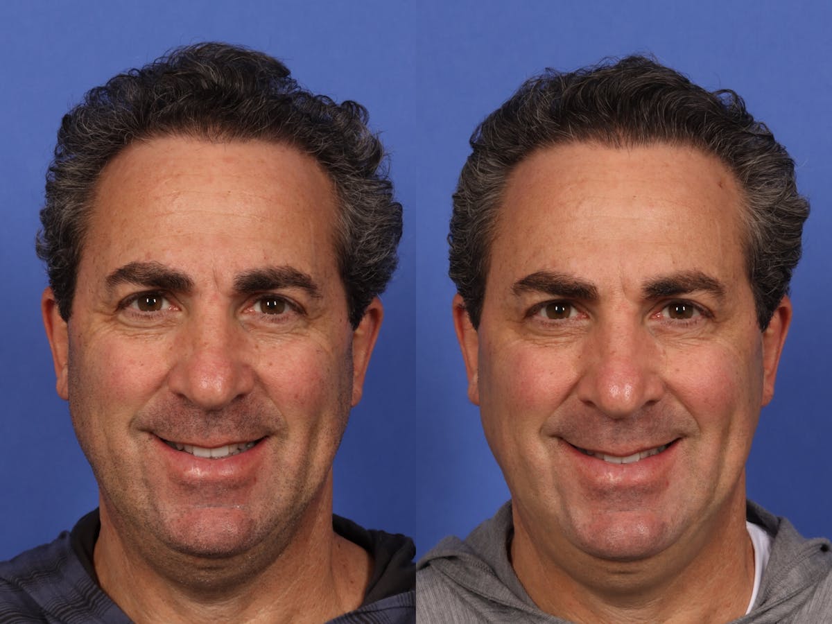 BOTOX® Before & After Gallery - Patient 753829 - Image 1