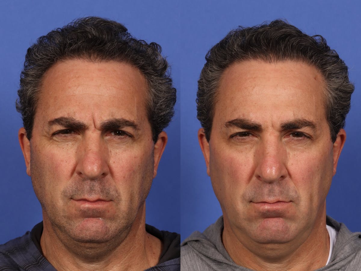 BOTOX® Before & After Gallery - Patient 753829 - Image 3