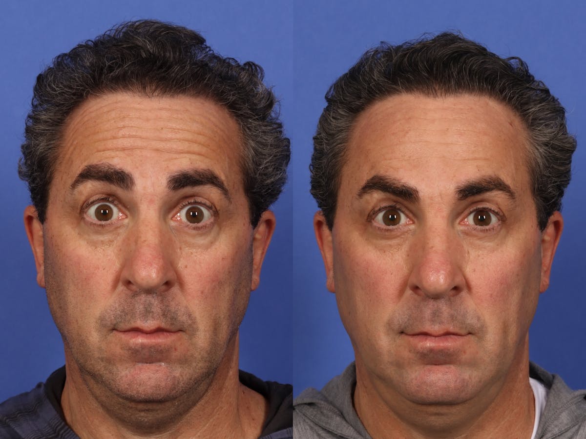 BOTOX® Before & After Gallery - Patient 753829 - Image 2