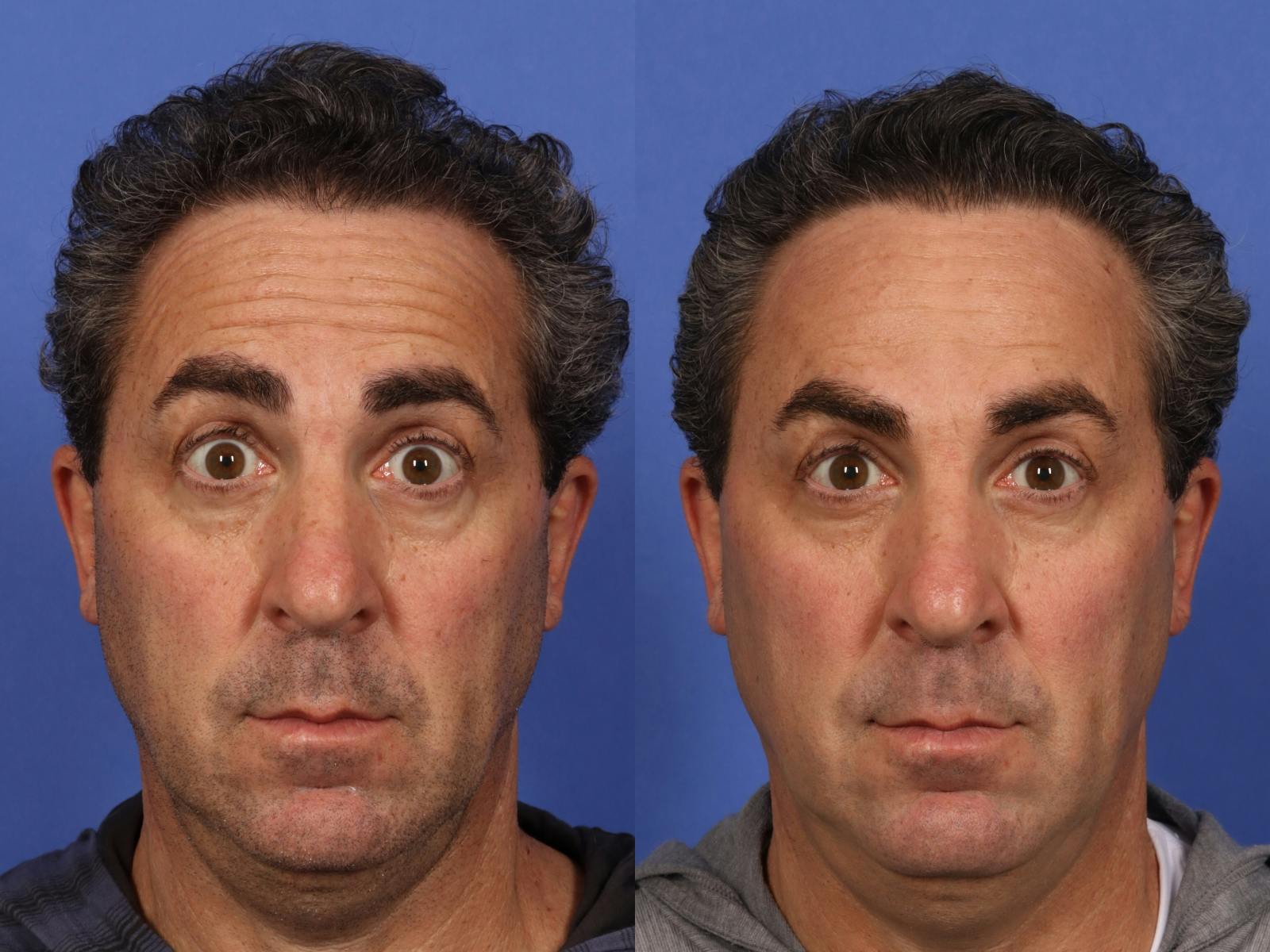BOTOX® Before & After Gallery - Patient 753829 - Image 2