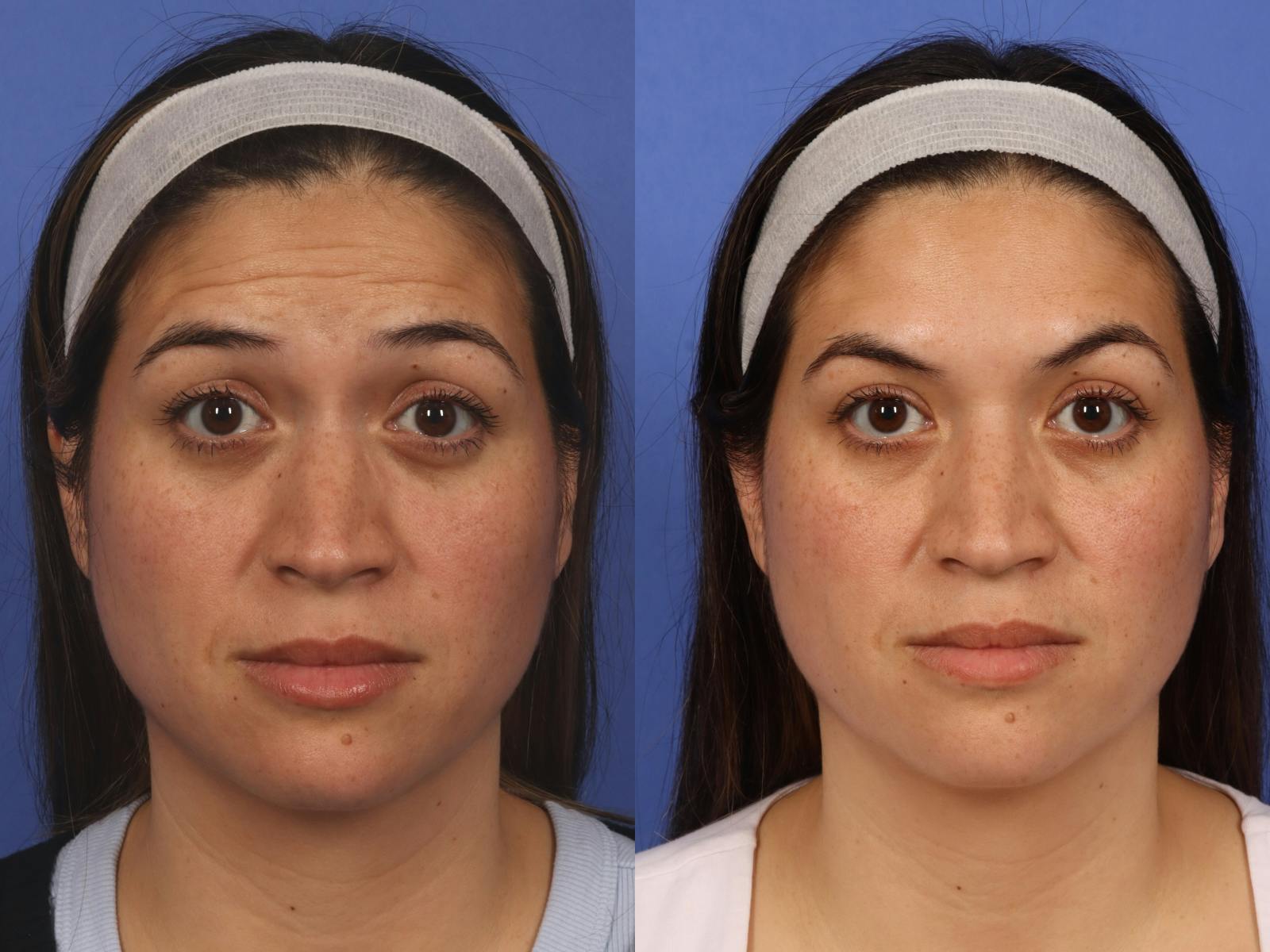 BOTOX® Before & After Gallery - Patient 319154 - Image 2