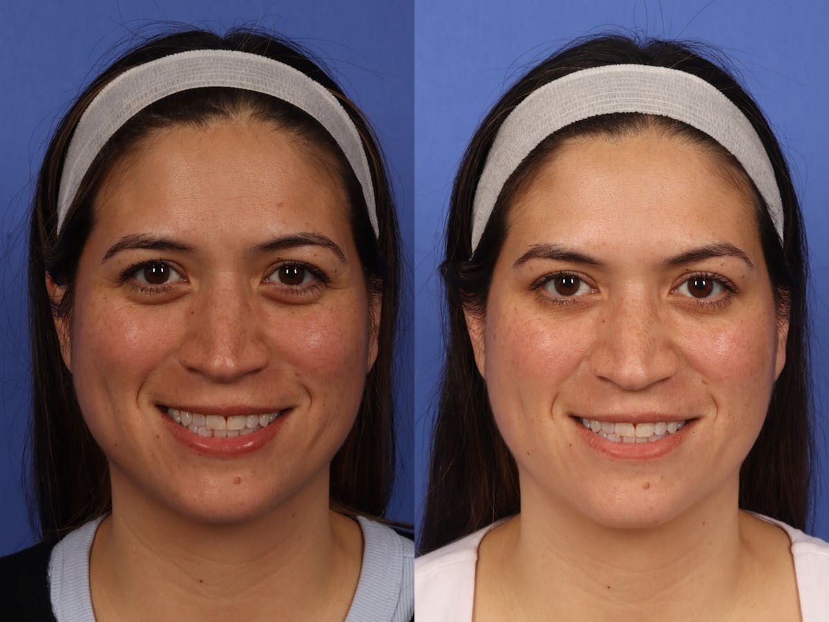 BOTOX® Before & After Gallery - Patient 319154 - Image 1