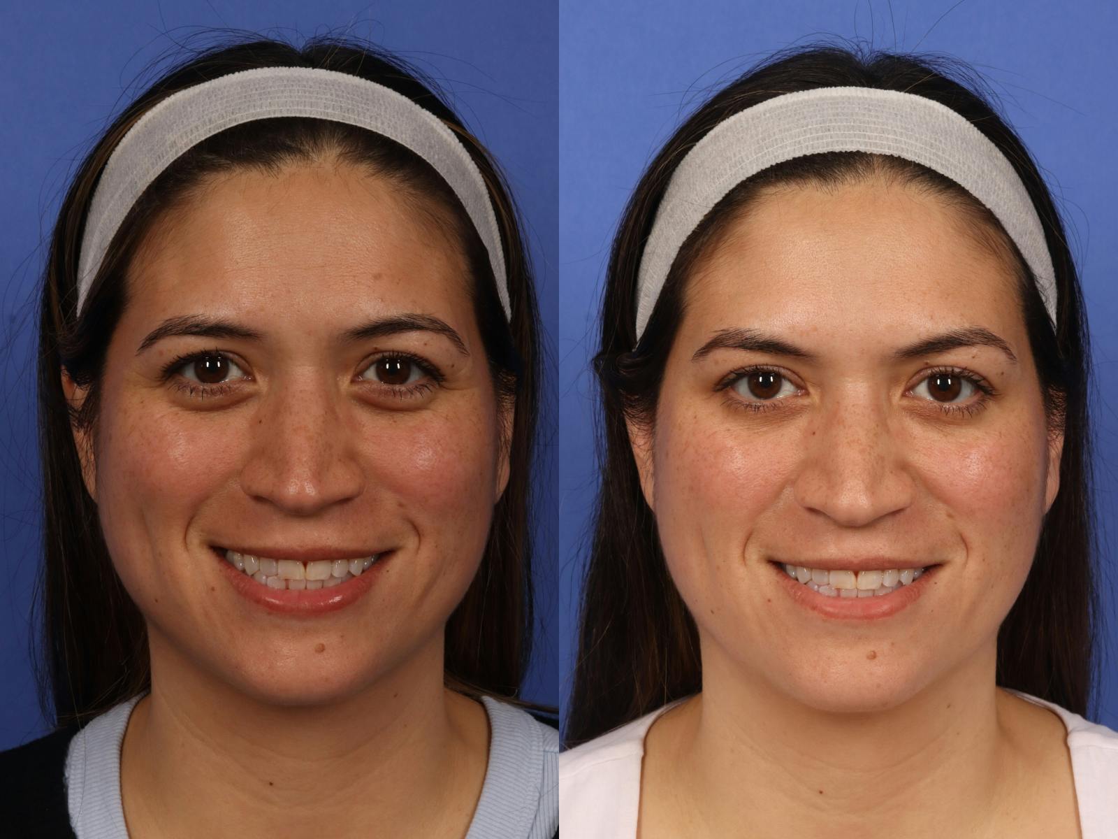 BOTOX® Before & After Gallery - Patient 319154 - Image 1