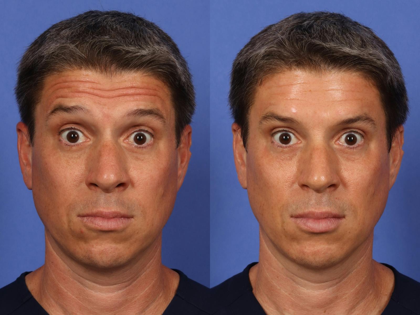 BOTOX® Before & After Gallery - Patient 476136 - Image 3