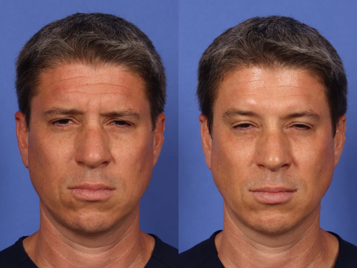 BOTOX® Before & After Gallery - Patient 476136 - Image 1