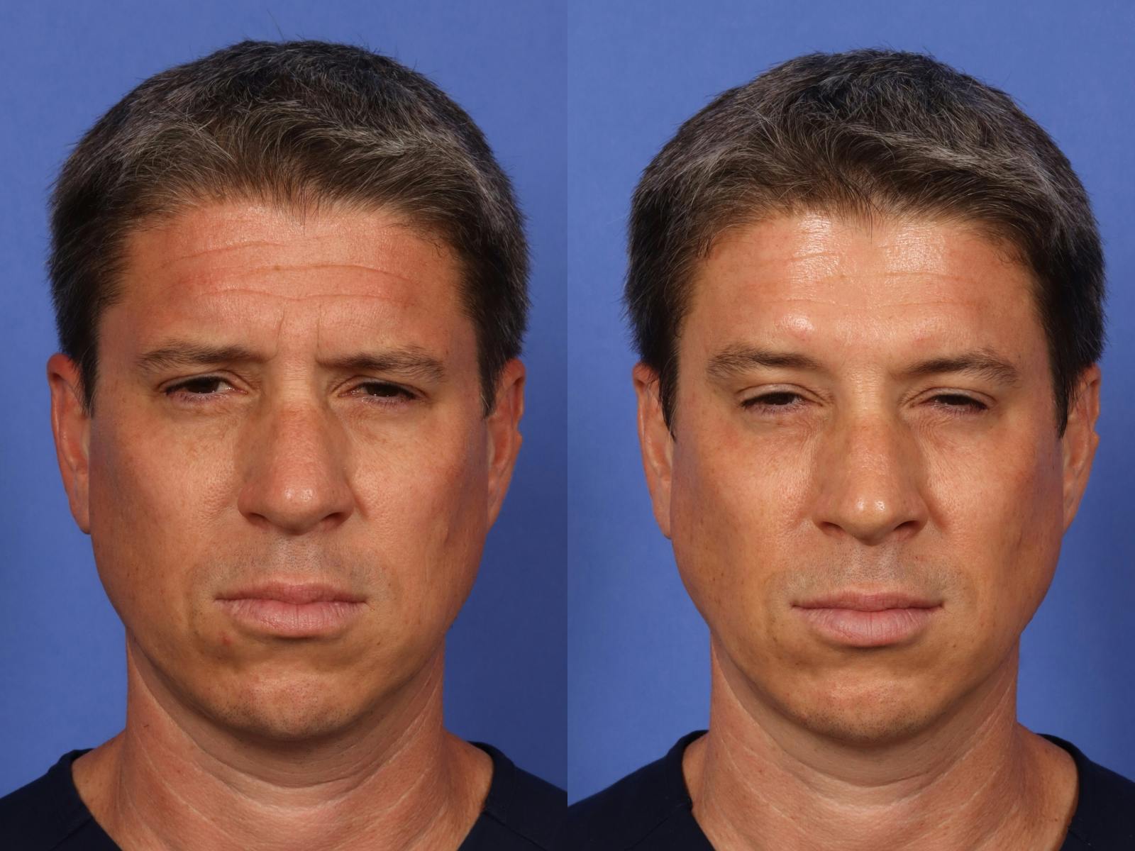 BOTOX® Before & After Gallery - Patient 476136 - Image 1