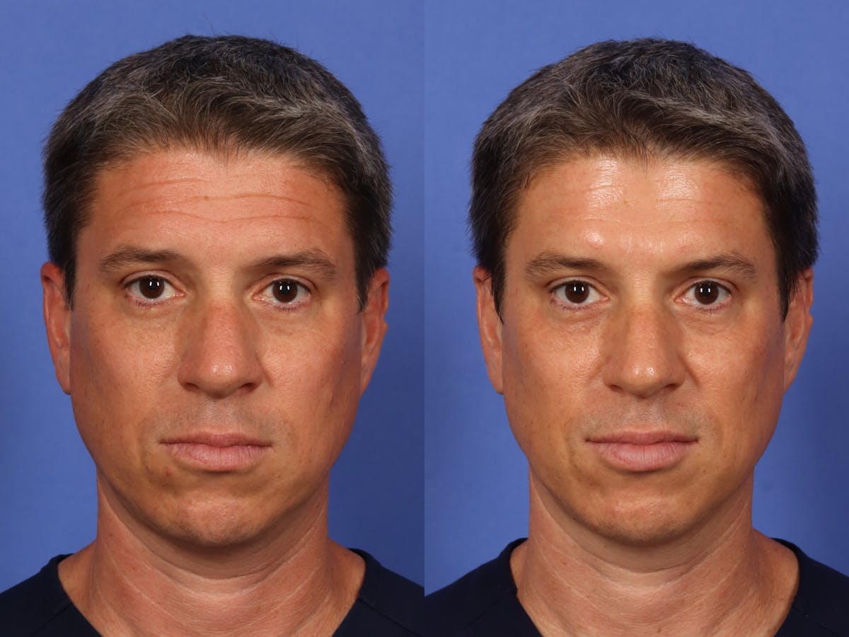 BOTOX® Before & After Gallery - Patient 476136 - Image 2
