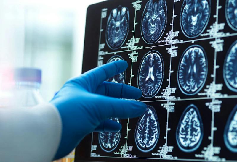A doctor pointing at a brain scan