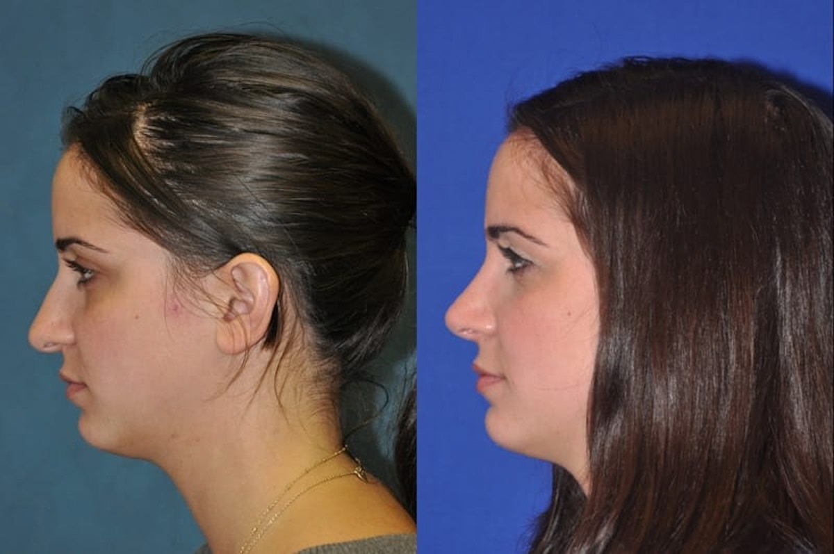 Rhinoplasty Before & After Gallery - Patient 873415 - Image 1