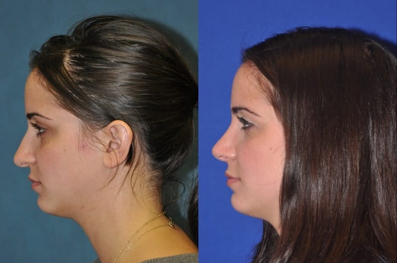 Rhinoplasty Before & After Gallery - Patient 873415 - Image 1