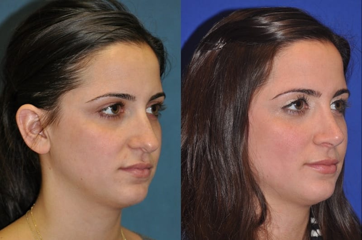 Rhinoplasty Before & After Gallery - Patient 873415 - Image 6