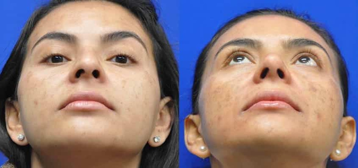 Rhinoplasty Before & After Gallery - Patient 296692 - Image 3