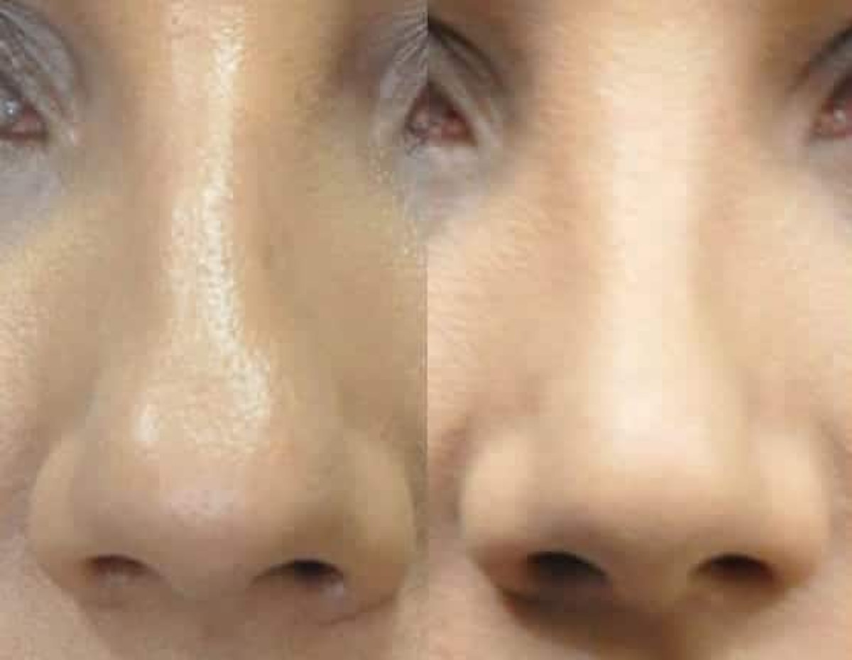 Rhinoplasty Before & After Gallery - Patient 378429 - Image 4