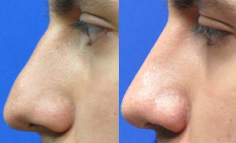 Rhinoplasty Before & After Gallery - Patient 209993 - Image 1