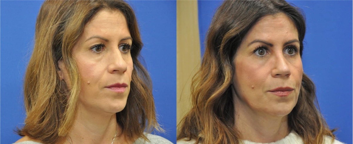 Rhinoplasty Before & After Gallery - Patient 271810 - Image 6