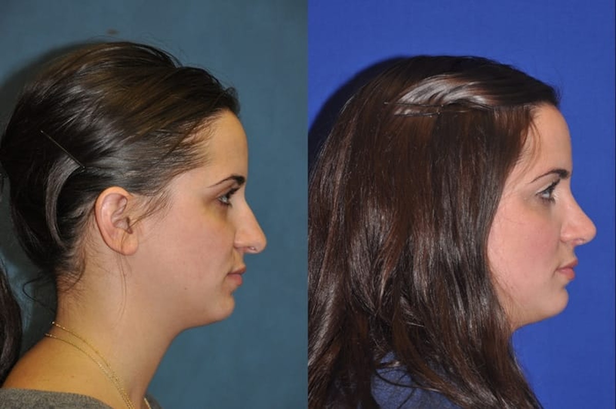 Rhinoplasty Before & After Gallery - Patient 873415 - Image 5