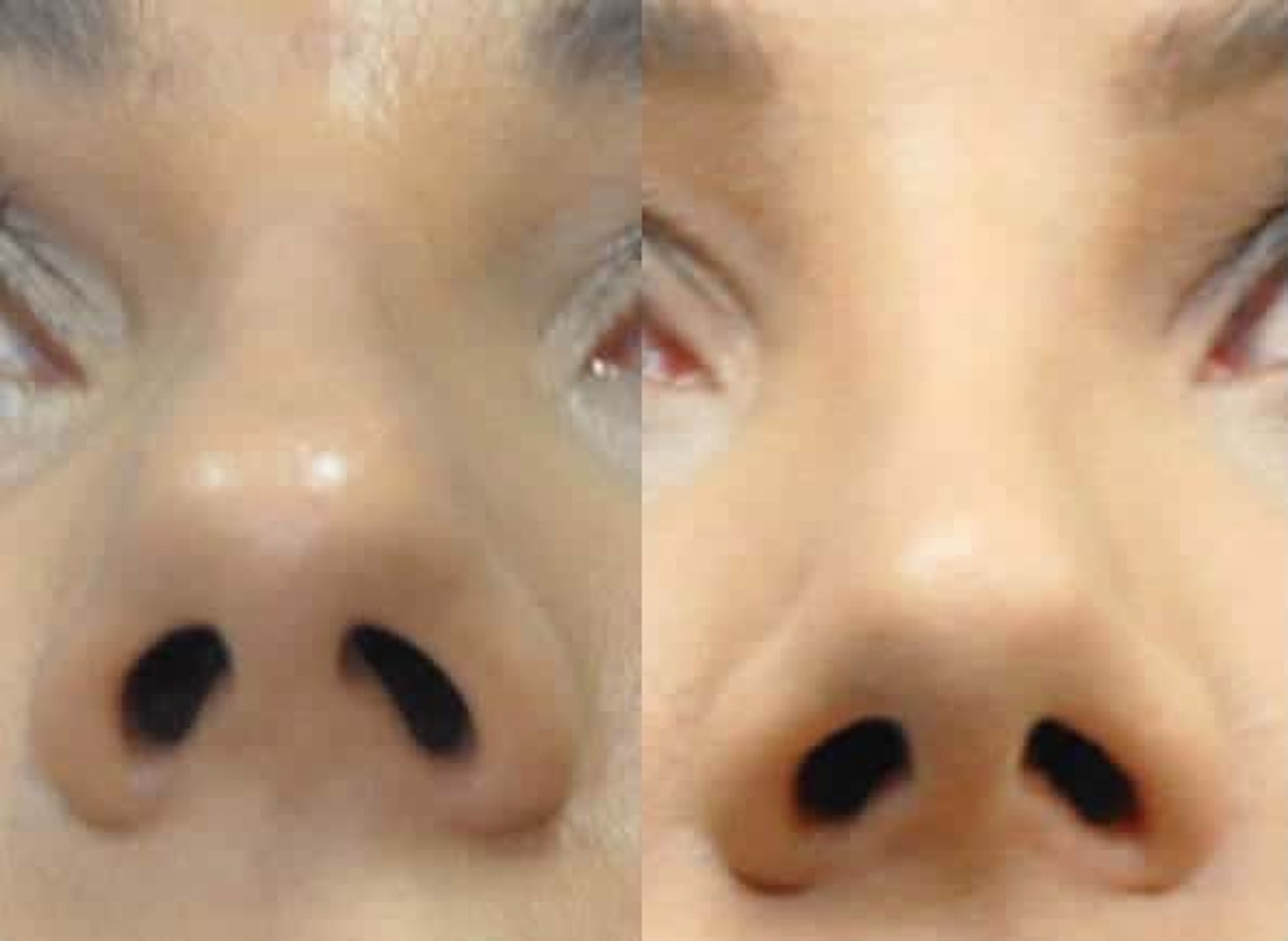Rhinoplasty Before & After Gallery - Patient 378429 - Image 3
