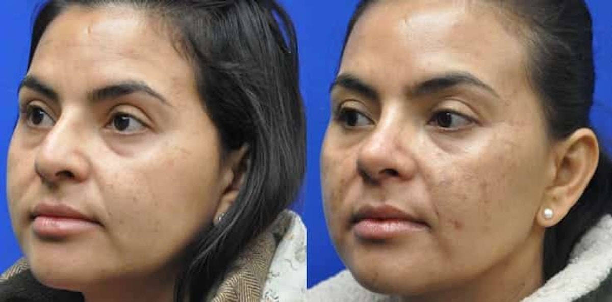 Rhinoplasty Before & After Gallery - Patient 296692 - Image 2