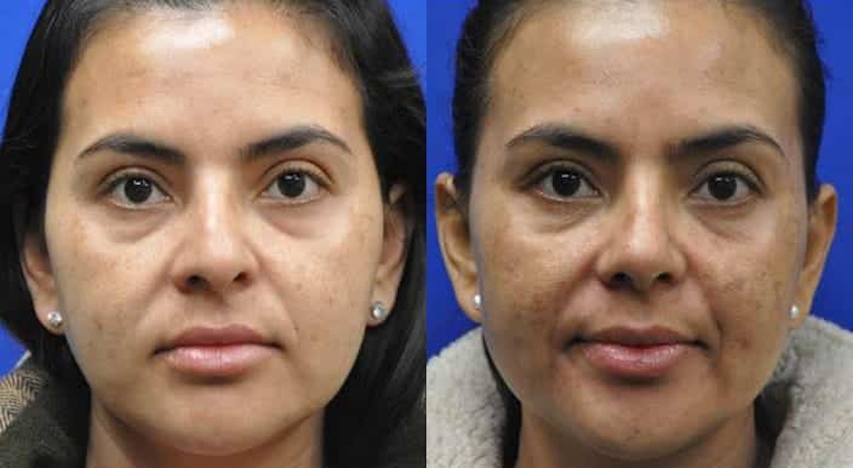 Rhinoplasty Before & After Gallery - Patient 296692 - Image 4