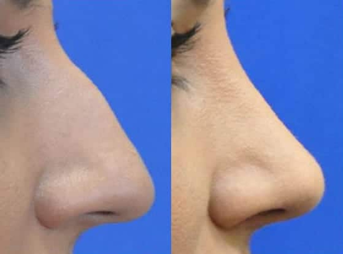 Rhinoplasty Before & After Gallery - Patient 378429 - Image 6